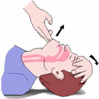 Hava yolu açıklığı sağlandıktan sonra bir eli alnına koyarak çeneyi 3 parmakla geriye itilmesine ne denir?